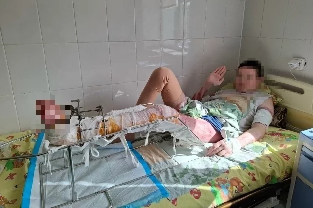 У 17-летнего подростка больше половины тела было в ожогах.